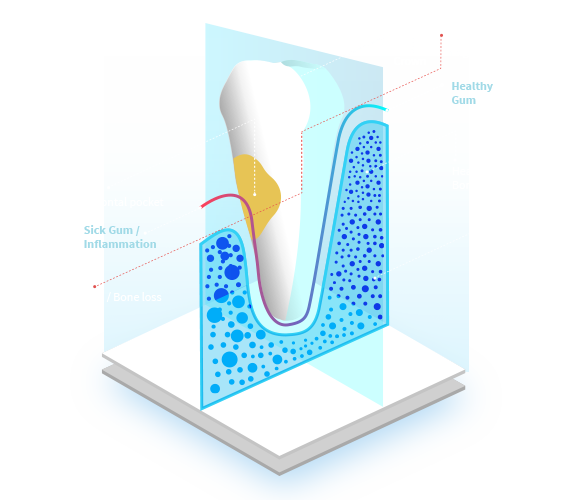 Cirugia-Periodontal-Peridontal-Surgery-2