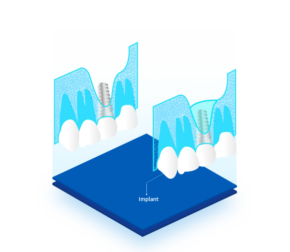 Elevacion-Seno-Maxilar-Sinus-Lift