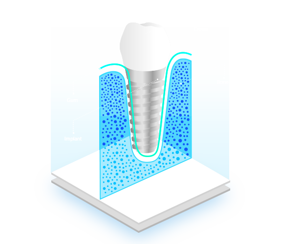 Implantes-Dentales-Dental-Implants