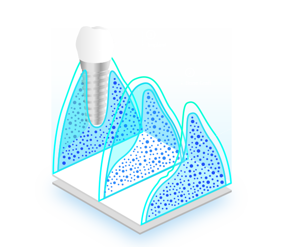 Injerto-Oseo-Bone-Grafting