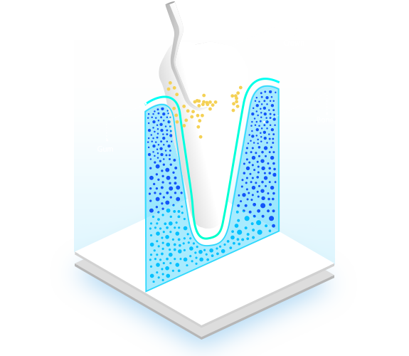 Raspado-Radicular-Deep-Cleaning