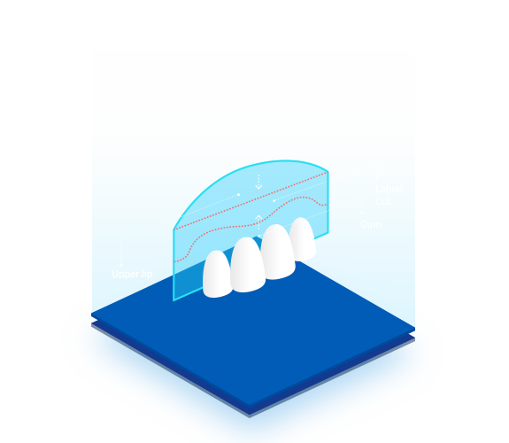 Reposicion-Labio-Lip-Reposition